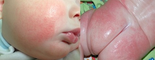 Сыпь на теле у ребенка