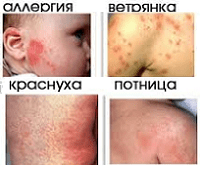 Сыпь на теле у ребенка. Фото с пояснениями.