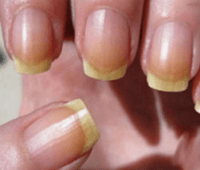 Основные причины появления желтизны на ногтях и способы лечения