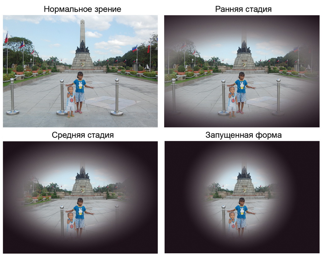 Как видят люди с разными нарушениями зрения фото