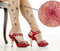 Варикозное расширение вен на ногах (варикоз) - причины, диагностика, симптомы и лечение