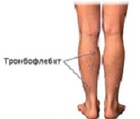 Тромбофлебит нижних конечностей: симптомы, фото и лечение